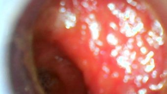 Endoscope深...
